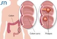Cáncer de Colon. Uno de los tumores más prevenibles y curables