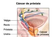 Cáncer de Próstata: más de 11.000 casos por año en la Argentina